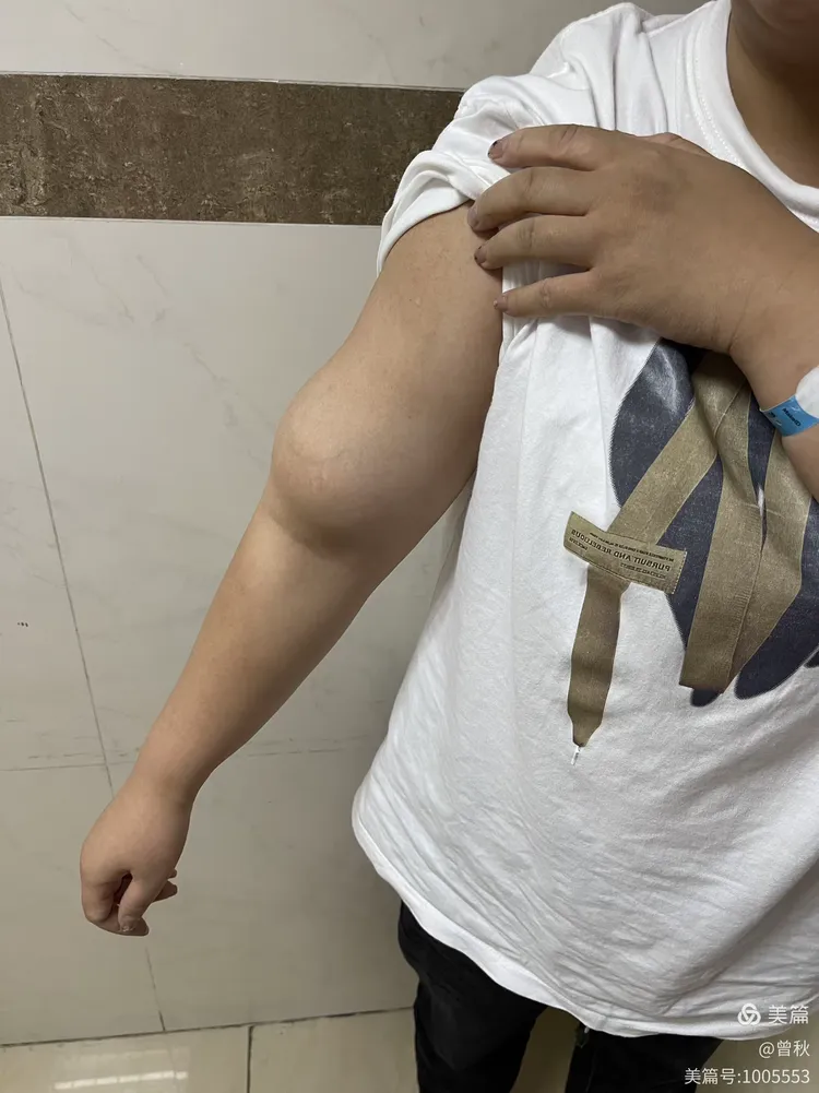 右上臂动静脉畸形治疗